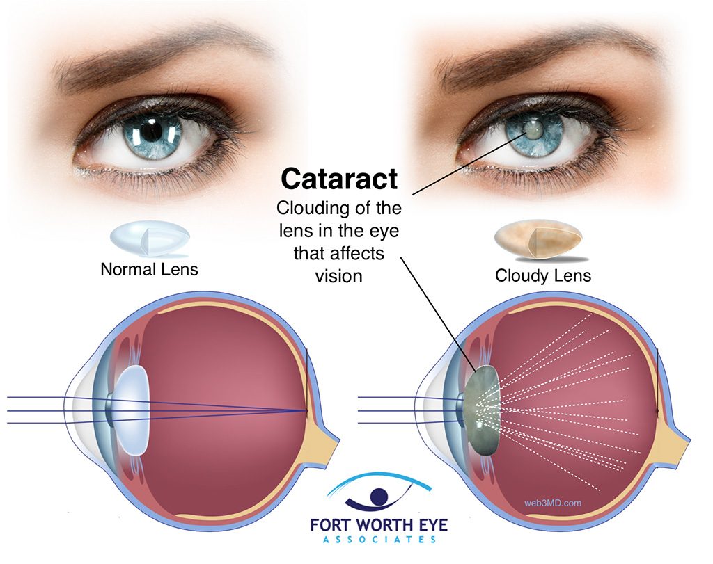 Линзы катаракта