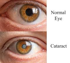 катаракта причины, катаракта симптомы, катаракта лечение