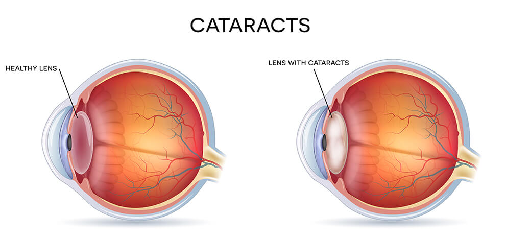 катаракта причины, катаракта симптомы, катаракта лечение